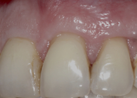 Replacement of the TMO membrane (dura mater) with connective tissue and bone tissue
