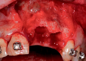 Surgical operations in which materials Lyoplast-S are used