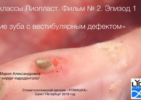 Operation 2. Removal of a tooth with a defect in one wall: vestibular or lingual