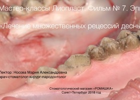 Operation 3. Preservation of the tooth cavity during tooth extraction with a through defect