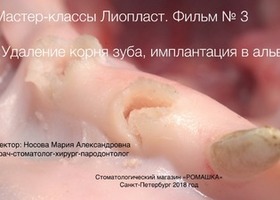 Operation 5. Preservation of the tooth hole during tooth extraction to the patient with periodontitis