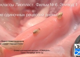 Operation 26. Surgical treatment of a single gum recession on the teeth