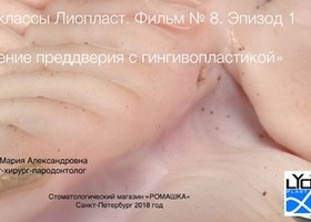 Operation 22. Plastic repair of the alveolar defect in atrophy and fine biotype of the gums