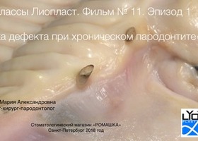 Operation 23. 3D al-veolar plastic surgery in patients with parodontitis using the Mix-MAX method