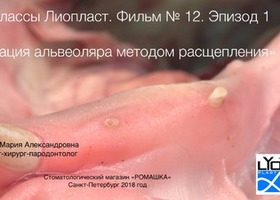 Operation 16. Alve-ololar plastics in width by splitting with implantation