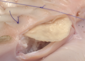 Instructions: Increase the volume of the attached gingiva with a Collagen membrane (dura mater)