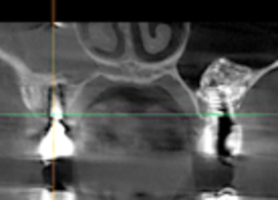 Instructions: Interval of delayed implantation after sinus lift