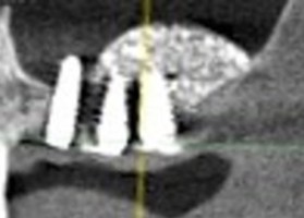Instructions: The need to close lateral access during sinus lift