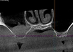Mix-MAX Lyoplast: Open Sine Lifting Operation for 7-10 mm or more
