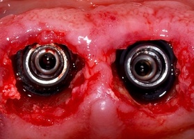 Operation 7. Tooth extraction together with implantation in the alveoli without defect