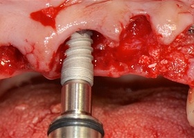 Operation 9. Tooth extraction together with implantation in a large alveoli