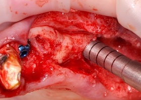 Operation 11. Implantation in the fourth type of bone tissue. Bone condensation