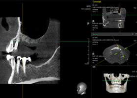 Operation 15. Plastic perforation of the Schneider membrane; perforation prevention