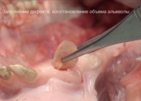 Operation 17. Alve-Olar plastic in width by the method of NTR without frame screws