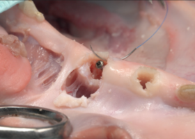 Operation 18. Plastic Alve-Olar width by the method of the NTR with frame screws