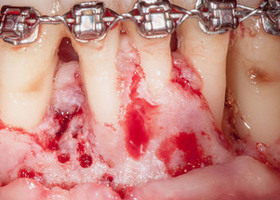 Operation 24. Orthodontic treatment of patients with periodontitis Mix-MAX