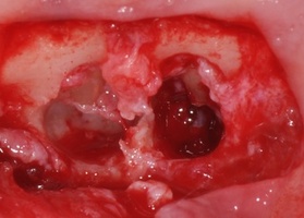 Operation 25. Resection of the apex of the tooth root, cyst ectomy; Mix-MAX plastic