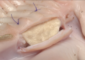 Operation 28. Thickening of the gum biotype before orthodontic treatment