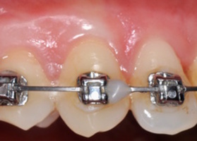 Operation 29. Creating the vestibule, attachment and thickening of the gum biotype