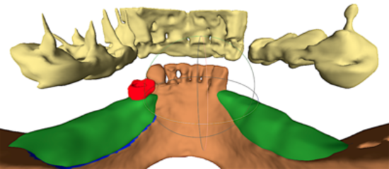 3D-Customized Bone Blocks RBB 