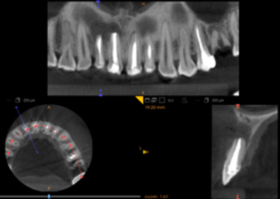 Effect of osteoplastic materials on bone regeneration after cystectomy