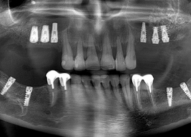 Comparison of allo-and xeno-materials for bone grafting with implantation No. 1