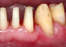 Elimination of gingival recession under the orthopedic construction on teeth No. 1