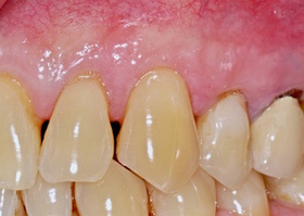 Surgical treatment of multiple gingival recessions with dura mater No. 3