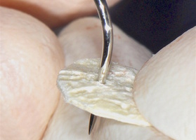 Elimination of gingival recession under the orthopedic construction on teeth No. 3