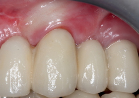 Elimination of gingival recession under the orthopedic construction on teeth No. 2