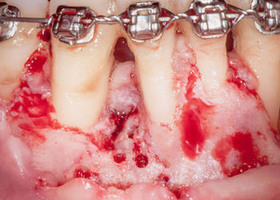 NTR with TMO (dura mater) in the area of teeth with chronic periodontitis