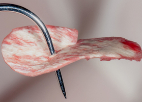 Surgical treatment of multiple gingival recessions with dura mater No. 2