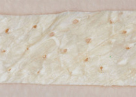 Surgical treatment of multiple gingival recessions with dura mater No. 0