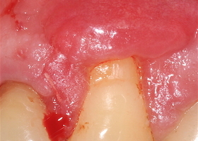 Surgical treatment of multiple gingival recessions with dura mater No. 11