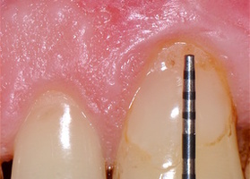 Surgical treatment of a single gum recession using single-layer technique No. 1
