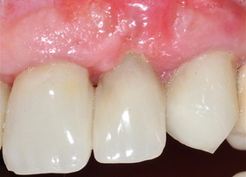 Periimplantitis treatment. Plastic defect Lioplast Mix-MAX with TMO (dura mater) No. 2