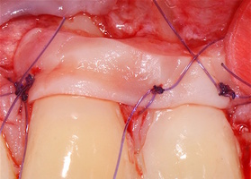 Surgical treatment of multiple gingival recessions with dura mater No. 9