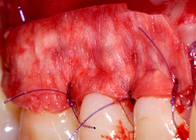 Surgical treatment of multiple gingival recessions with dura mater No. 10