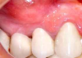 Removal of an odontogenic cyst with resection of the apexes of the roots of the teeth and plastic repair of defect No. 1