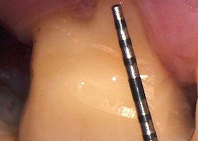 Surgical treatment of multiple gingival recessions with dura mater No. 12