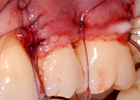 Surgical treatment of multiple gingival recessions with No. 1 transplant