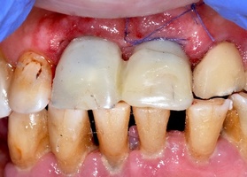 Removal of teeth and roots, alveolar plastics, NTR, together with implantation No. 4