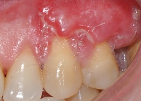 Surgical treatment of multiple gingival recessions with TMO (dura mater) No. 13