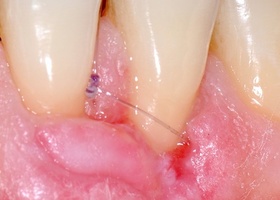 Surgical treatment of multiple gingival recessions with No. 2 transplant