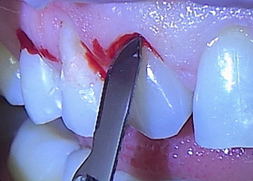 Surgical treatment of multiple gingival recessions with dura mater No. 15