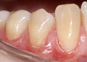 Surgical treatment of multiple gingival recession with TMO (dura mater) No. 17