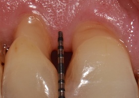 Surgical treatment of multiple gingival recession with No. 6 transplant
