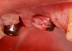 Gum plastics in the area of gum cuff formers No. 2