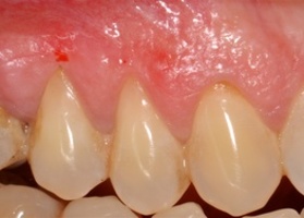 Surgical treatment of multiple gingival recession with dura mater No. 20