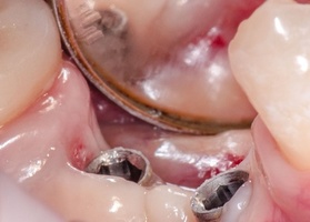 Gum plastics in the area of gum cuff formers No. 1